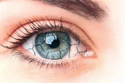 occhio secco: immagine di occhio asciutto